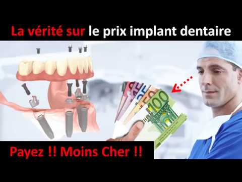 Prix implant dentaire -  partie 1