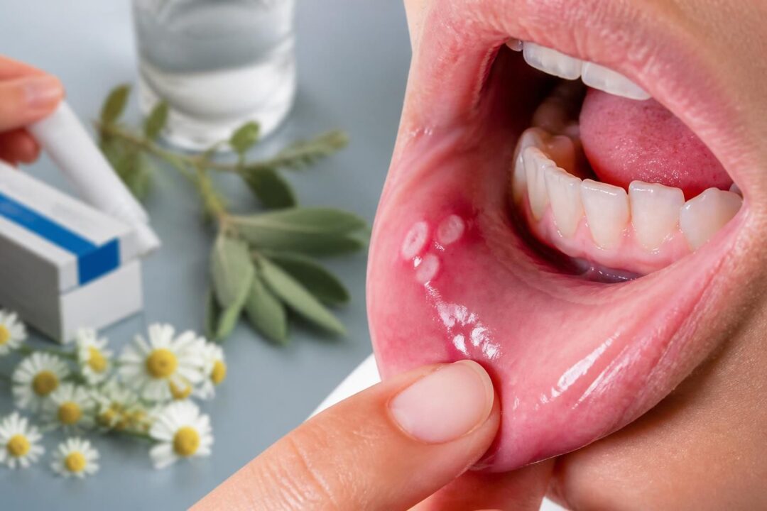 découvrez les principales causes des aphtes en bouche et les traitements efficaces pour soulager rapidement la douleur et favoriser la guérison.