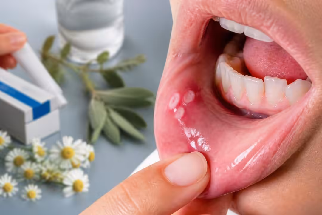 découvrez les principales causes des aphtes en bouche et les traitements efficaces pour soulager rapidement la douleur et favoriser la guérison.